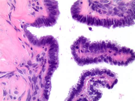 Pathology Outlines Serous Cystadenoma Adenofibroma And Surface Papilloma