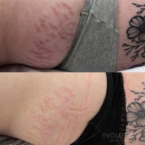 Stretch Mark And Scar Reduction Laser Stretch Mark And Scar Removal Elc