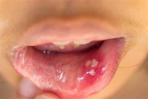1000 Mouth Blisters Stock Photos Pictures And Royalty Free Images Istock