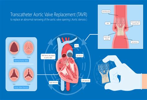 Effective Treatment Options For Aortic Stenosis In India Add More To