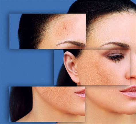 How Can I Get Rid Of Those Dark Spots Of Melasma On My Face