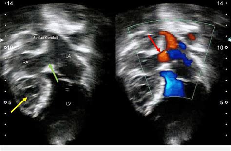 Echocardiogram Showing A Hypoplastic Right Ventricle Yellow Arrow And
