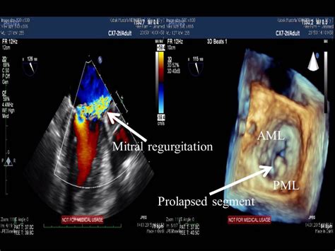 Anesthetic Management Of Transapical Off Pump Mitral Valve Repair With