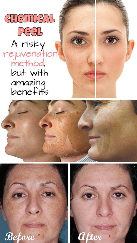 Chemical Peel A Risky Rejuvenation Method But With Amazing Benefits
