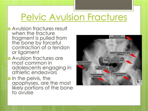 Pelvic Avulsion Fracture