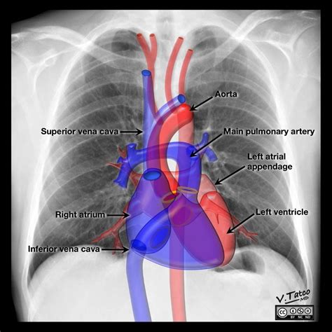 Right Cardiac Border X Ray Elitetsonline