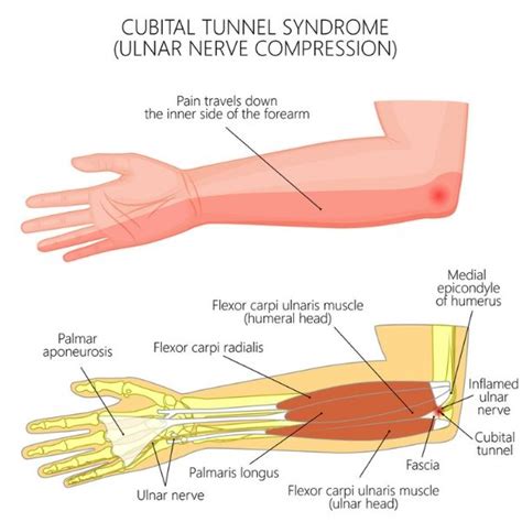 What Is Ulnar Nerve Compression At The Elbow Ulnar Nerve Ulnar Images