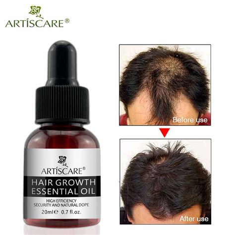 Hair growth continued for three more months after the treatment had stopped. ARTISCARE Hair Growth Essential Oil Hair Care Repair ...