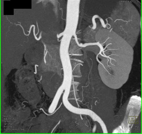 Fmd Fibromuscular Dysplasia Of The Renal Arteries Vascular Case