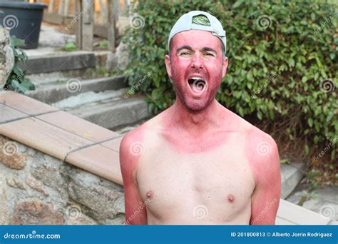 Man With Pale Complexion Getting Sunburnt Stock Image Image Of Male