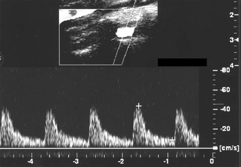 A Spectrum Of Doppler Waveforms In The Carotid And Vertebral Arteries Ajr