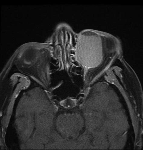 Orbital Dermoid Tumor Mri Radrounds Radiology Network