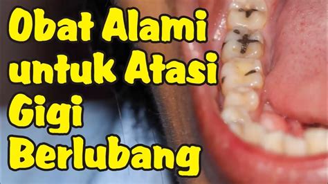 Obat Alami Untuk Mengatasi Gigi Berlubang YouTube