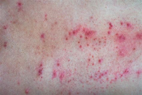 Are Allergies Causing Your Skin Sensitivity Vibrance Medspa