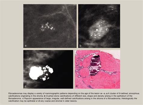 Benign Microcalcification And Its Differential Diagnosis In Breast Screening Diagnostic