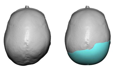 Plastic Surgery Case Study Custom Skull Implant For Occipital