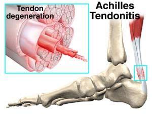 Learn more from webmd about achilles tendon injuries, including their causes, symptoms, diagnosis, treatment, and prevention. Achilles tendonitis. Most diabetics are likely to grapple ...