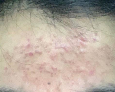 Deep Cystic Acne Scarring On Forehead Will It Go Away With Treatment