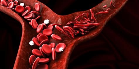 Sickle cell anemia can be a disabling blood disease | The ...