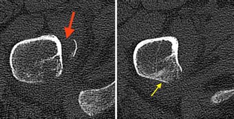 The apophysis is a secondary centre of ossification contributing to avulsion fractures of the lesser trochanter, greater trochanter, and iliac crest are less common.5 although not as common as other avulsions in the. CT scan of the right trochanter area and reconstruction in ...