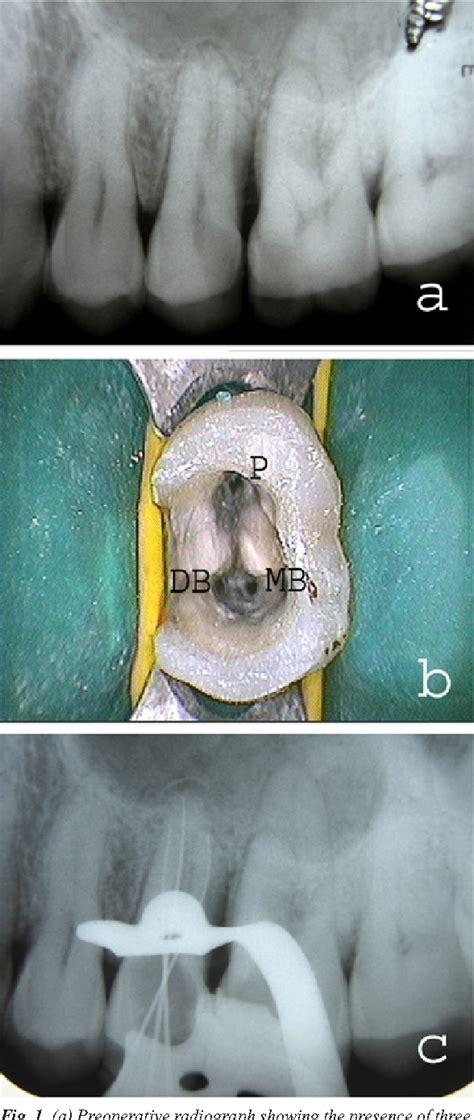 Figure 1 From Endodontic Management Of Three Rooted Maxillary Second