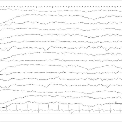 Interictal Eeg During Sleep At The Age Of 13 Months After Acth Therapy