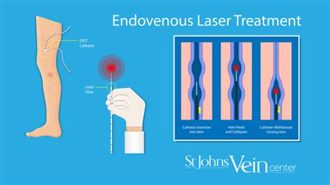 Endovenous Ablation Vein Treatment For The First Coast Of Jacksonville