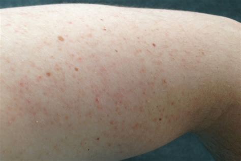 Central Skin Keratosis Pilaris How To Identify And Treat This