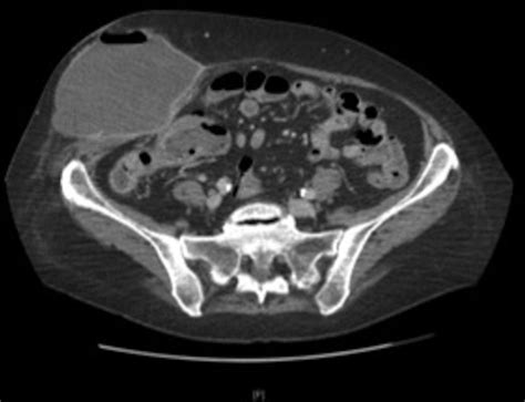 Atypical Presentation Of Appendicitis Bmj Case Reports