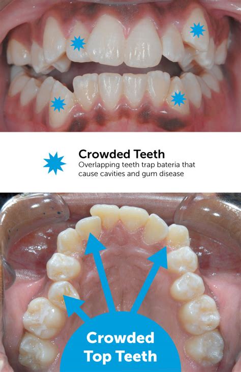 Crowded Top Teeth Made Straighter With Braces · South Brunswick Nj