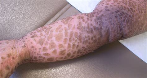 Important Matters You Need To Know About Ichthyosis Vulgaris