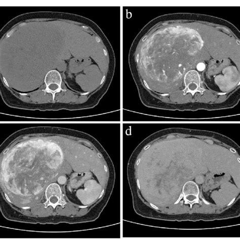 Contrast Enhanced Abdominal Computed Tomography Ct Plain Ct Shows A