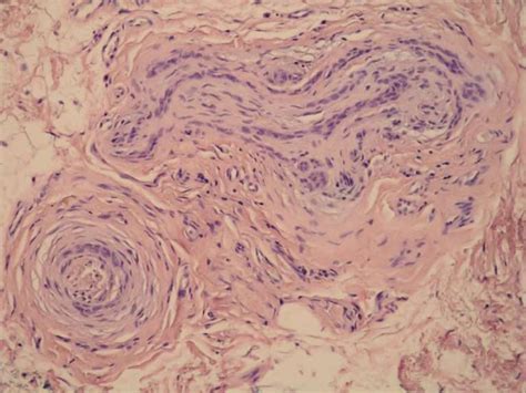 Microcystic Adnexal Carcinoma Bosnianpathology