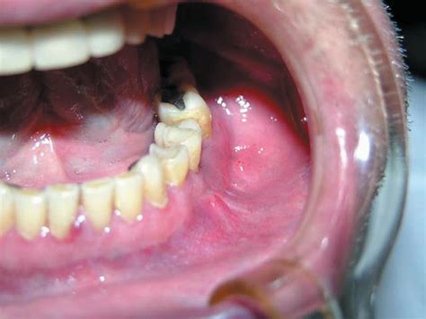 What Does Bone Cancer In The Mouth Look Like Oral Cancer Signs