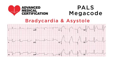− monitor / place defibrillator (pacing) pads − maintain airway, give algorithm for the management of ventricular tachycardia electrical storm es diagnosed (≥ 3 episodes of vt/icd therapies in 24h) does patient have icd? PALS Megacode - Bradycardia & Asystole