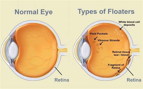 Eye Floaters Black Eye Floaters And Eye Flashes Causes And Treatment