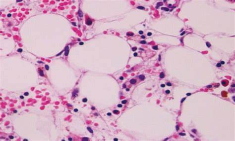 Анемия лечение диетой Апластическая анемия: суть заболевания, его симптоматика, диагностика и Апластическая анемия: суть заболевания, его симптоматика, диагностика и Анемия лечение диетой