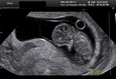 How Accurate Are Dating Scans At 9 Weeks How Accurate Is A Dating