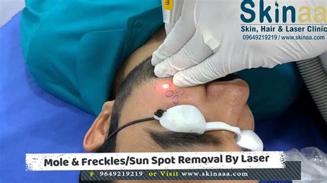 Sun Spots Removal Treatment By Nd Yag Q Switched Laser Youtube