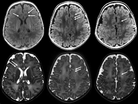 White Matter Injury And Structural Anomalies In Infants With Prenatal