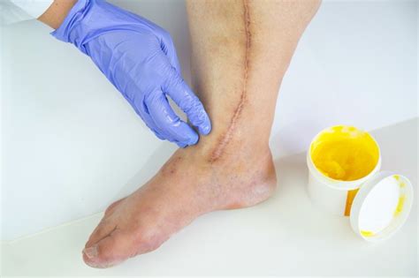 Ointments And Treatments For Healing Scars Livestrongcom