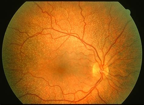 Fundus Albipunctatus Retina Image Bank