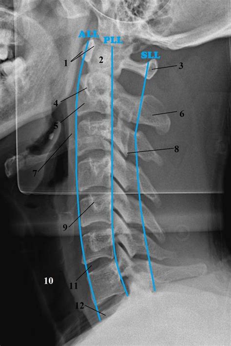 Interpreting Cervical Spine Radiographs The Bmj My XXX Hot Girl
