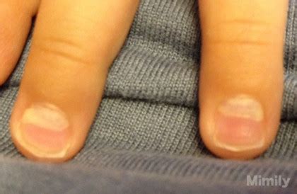 かわいい子供たちの画像: 驚くばかり子供 足の爪 剥がれる 原因