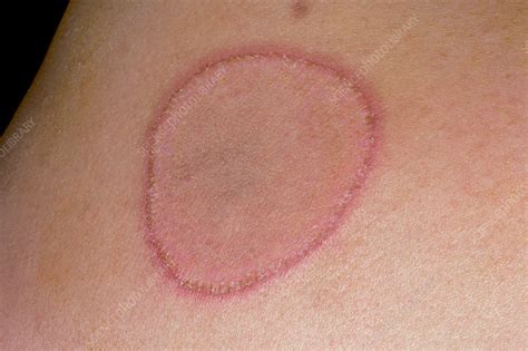 Drug Induced Skin Rash Stock Image C0348794 Science Photo Library