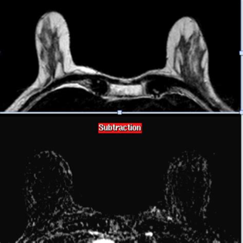 Ultrasound Reveals An Oval Hyperechoic Lesion In The Left Breast 4