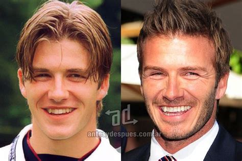 David Beckham And His New Teeth Before And After After Beckham