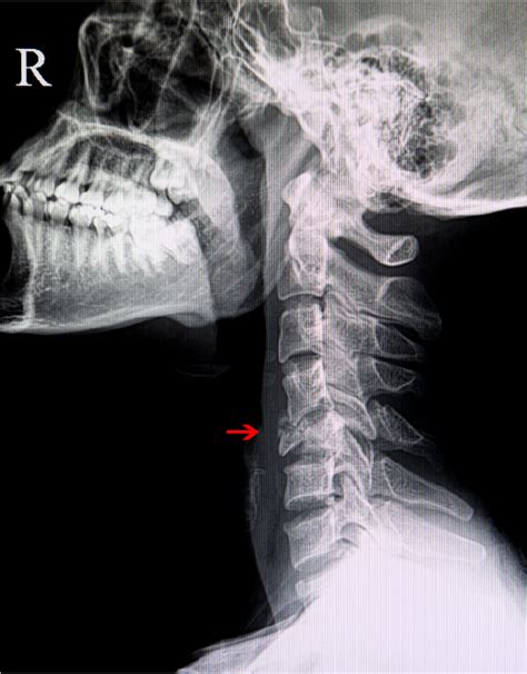 Spine Conditions Cervical Cervical Fracture Neurepair Clinic