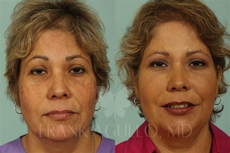Before And After Photos Fat Injections 3 Frank Agullo Md