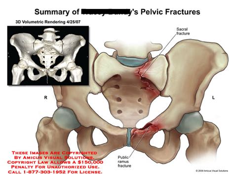 Inferior Pubic Ramus Related Keywords & Suggestions ...